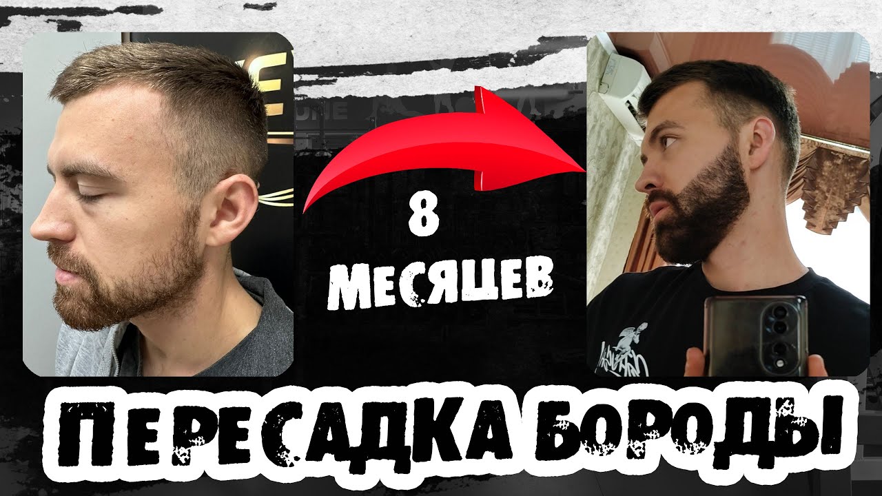 Пересадка бороды, спустя 8 месяцев / Андрей борода / Выпуск 39