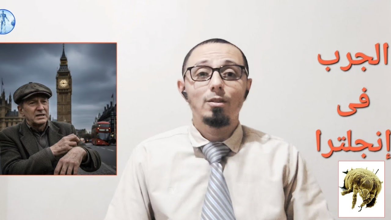 الجرب فى بريطانيا و فرنسا و اسبانيا و اسباب انتشارة و العلاج
