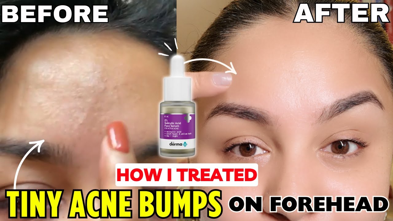 With 1 Serum i got rid of my Tiny Acne Bump on my Forhead (Before After with proof)*Closed Comedones