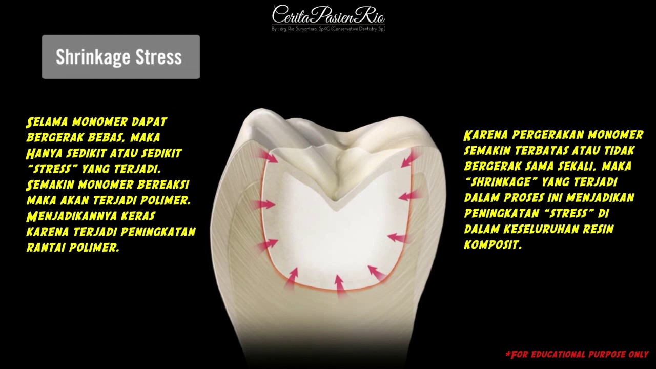 POLYMERIZATION SHRINKAGE STRESS IN COMPOSITE RESIN DENTISTRY EDUCATION IN ENGLISH ❌ INDONESIA 🦷❗️