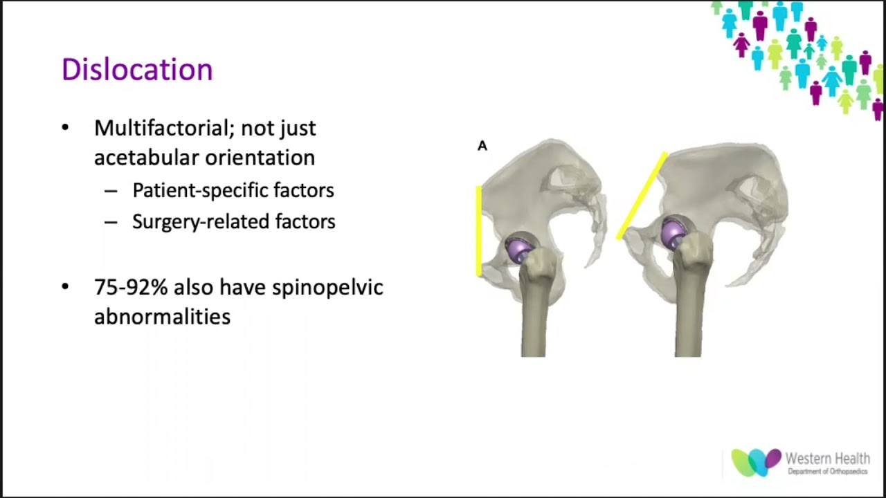 OrthoFracs Hip-spine relationship in total hip arthroplasty by Dr. Karen Bourns