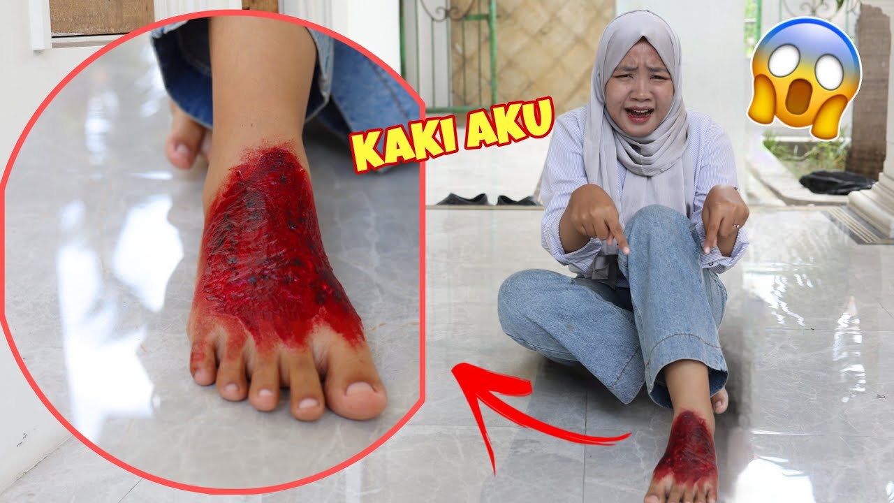 GAWAT!! | KAKI IYAL TERBAK4R KENA PET4S4N 2 BURIK | CHIKAKU FAMILY