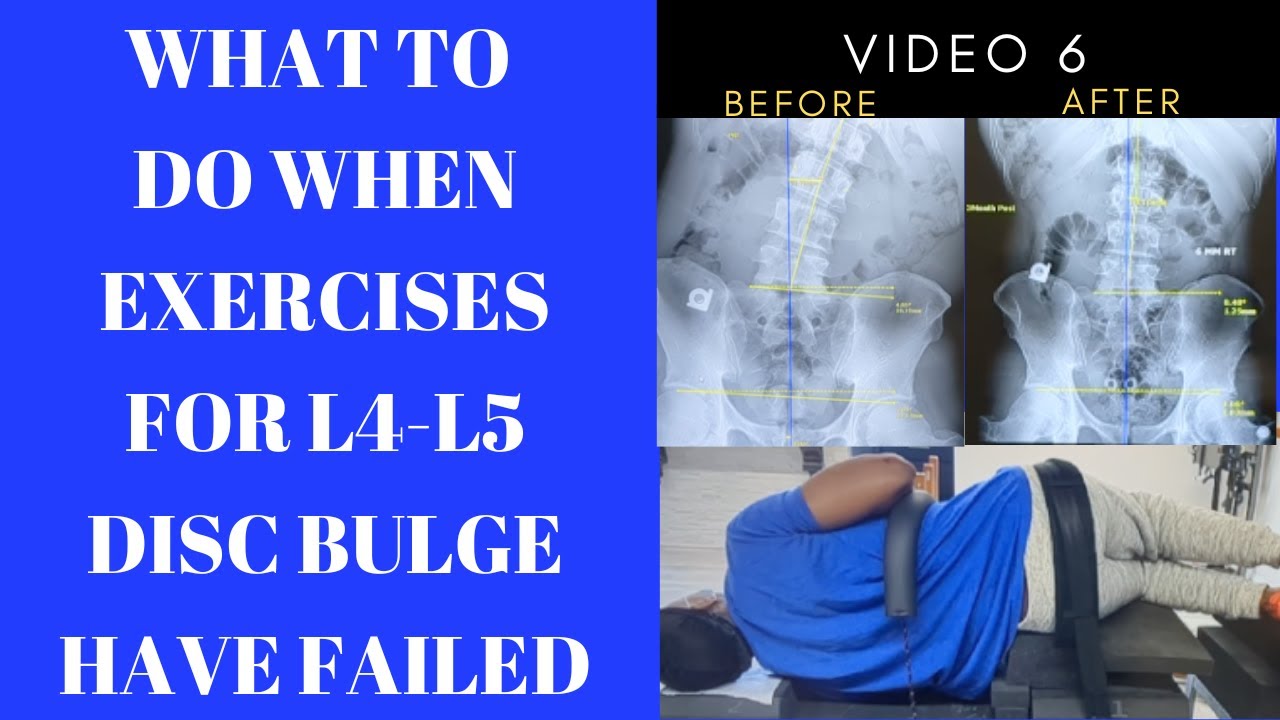 What to do When Exercises for L4-L5 Disc Bulge Have Failed | Dr. Greg Kramer Chiropractor Livonia Mi