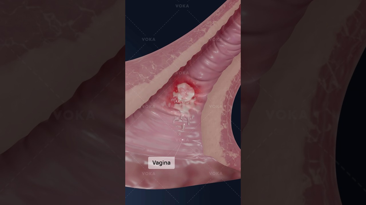 What is syphilitic vaginitis and how can an STI cause vaginal inflammation? Gynecology in 3D