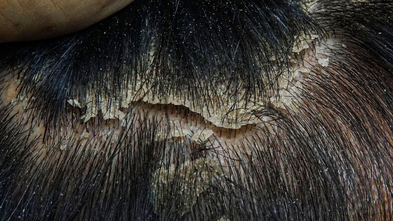 ASMR Satisfying Dandruff & Scalp Flakes Removal | Deep Comb Scratching #DKM03739