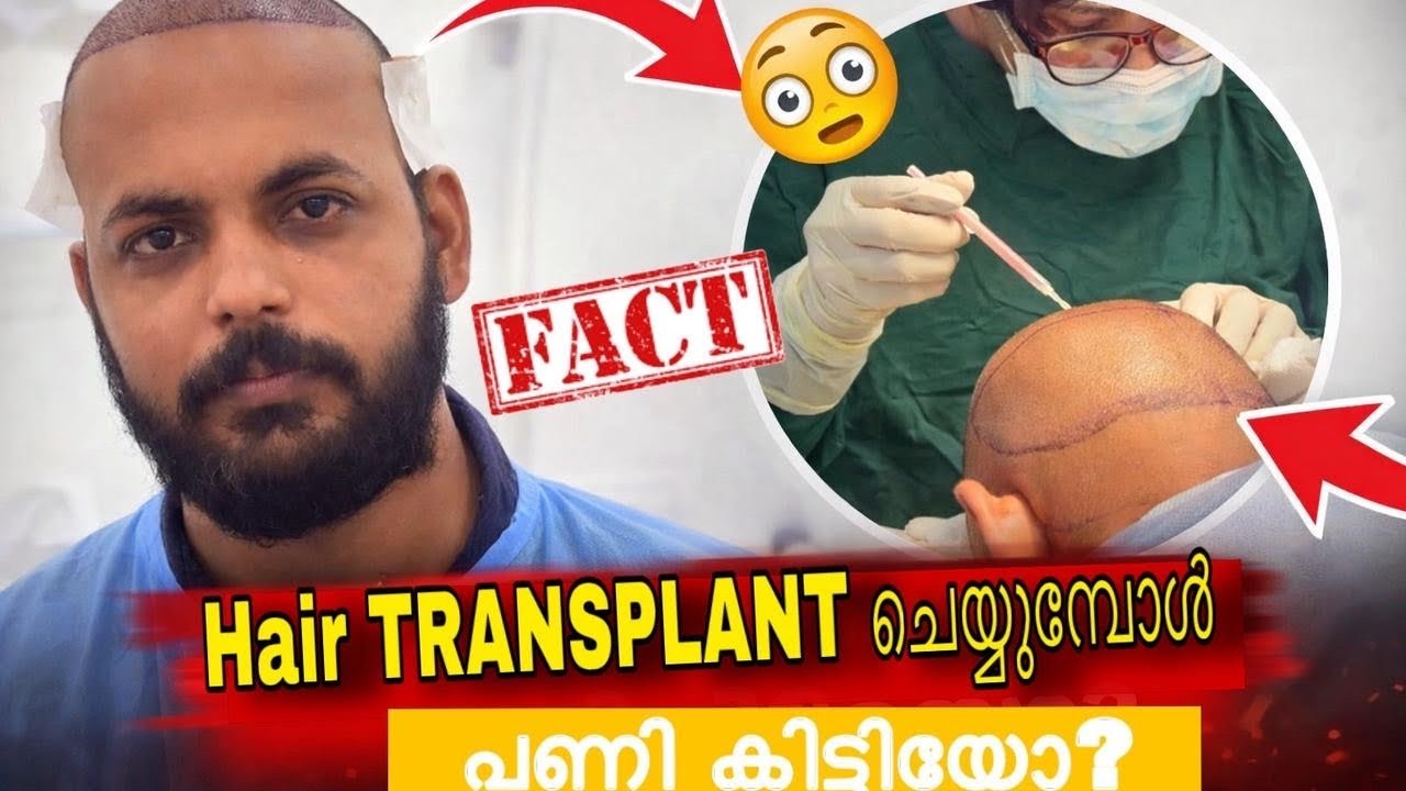 My hair Transplant experience??ശെരിക്കും അപകടമാണോ!!!!| Day 1 to 30days feedback|Cosmediks|Reality