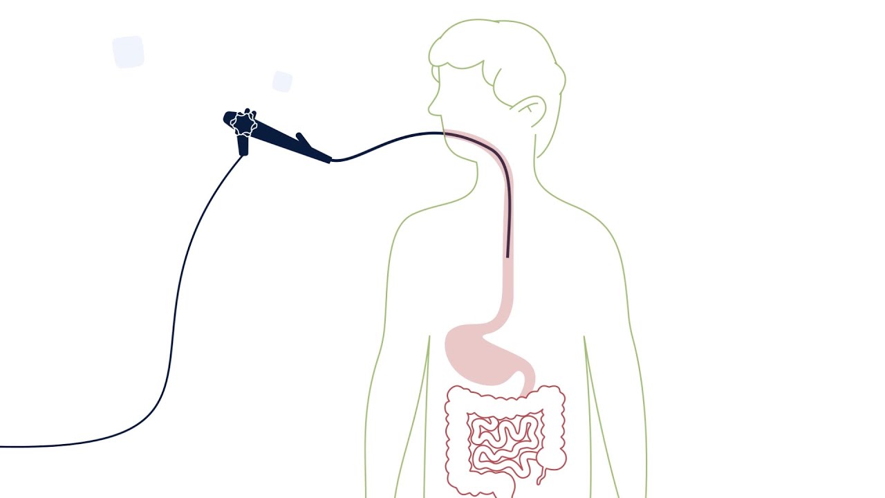 What is an Esophagogastroduodenoscopy (EGD)