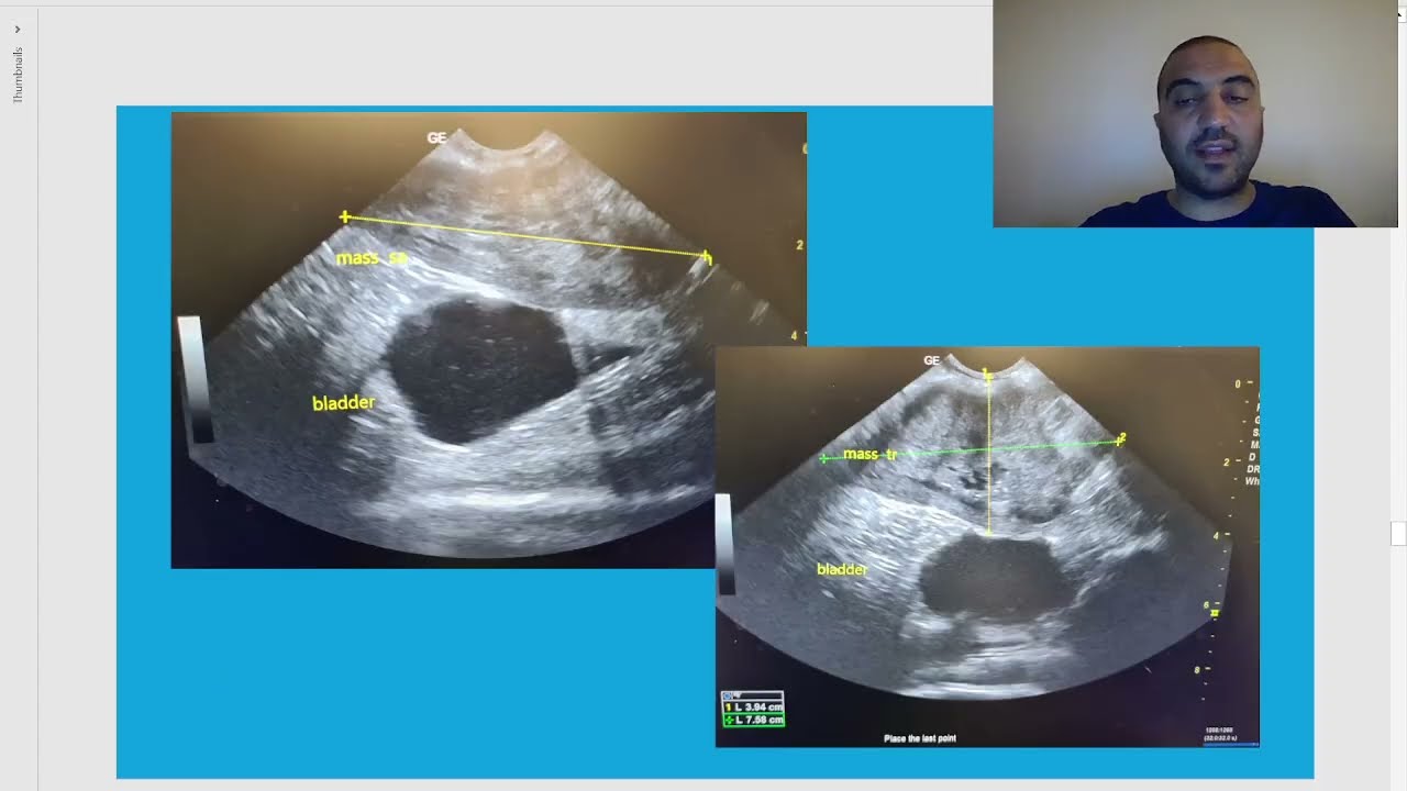 Chapter 13 mini clinical: معندوش   constipation body wall mass ?