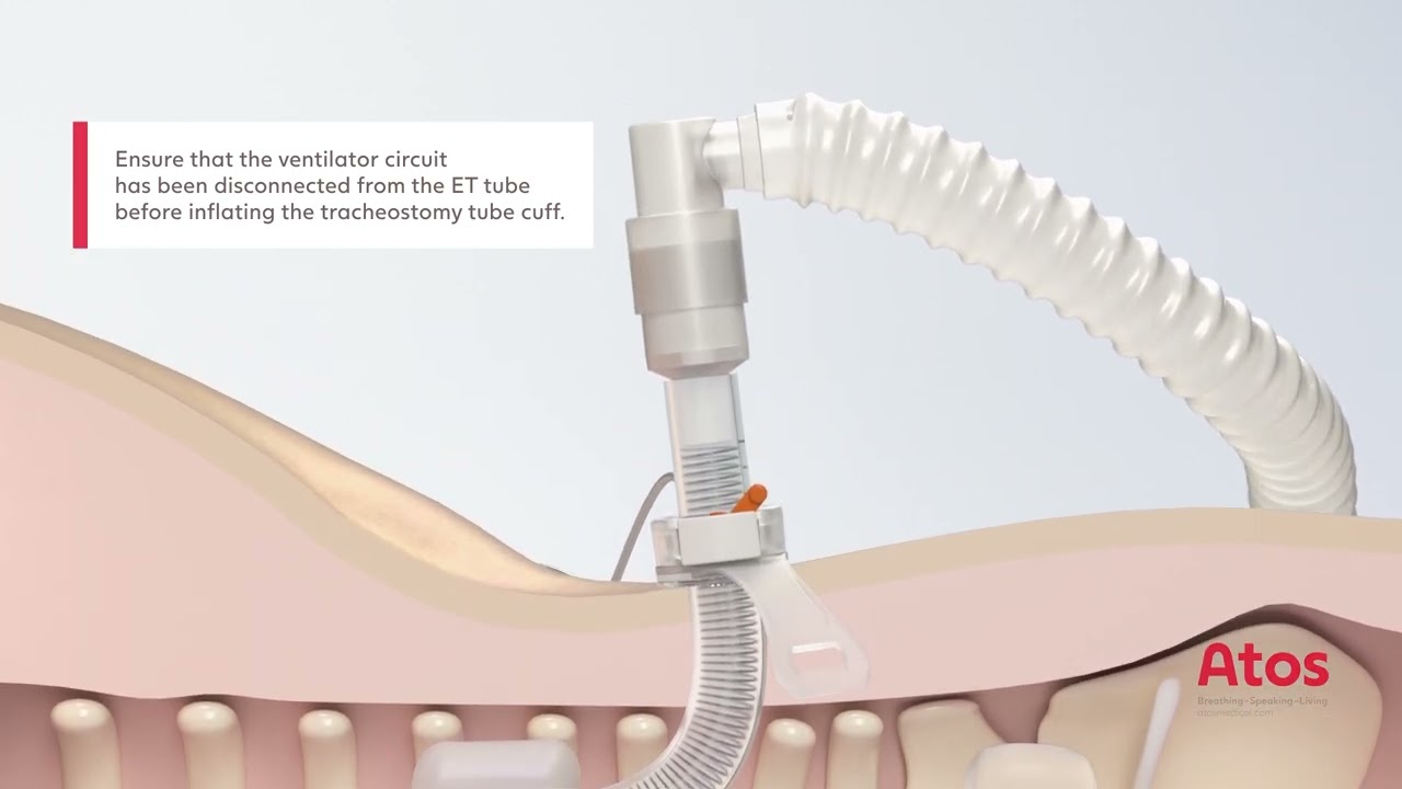 Animation video Tracoe Vario P-tube insertion