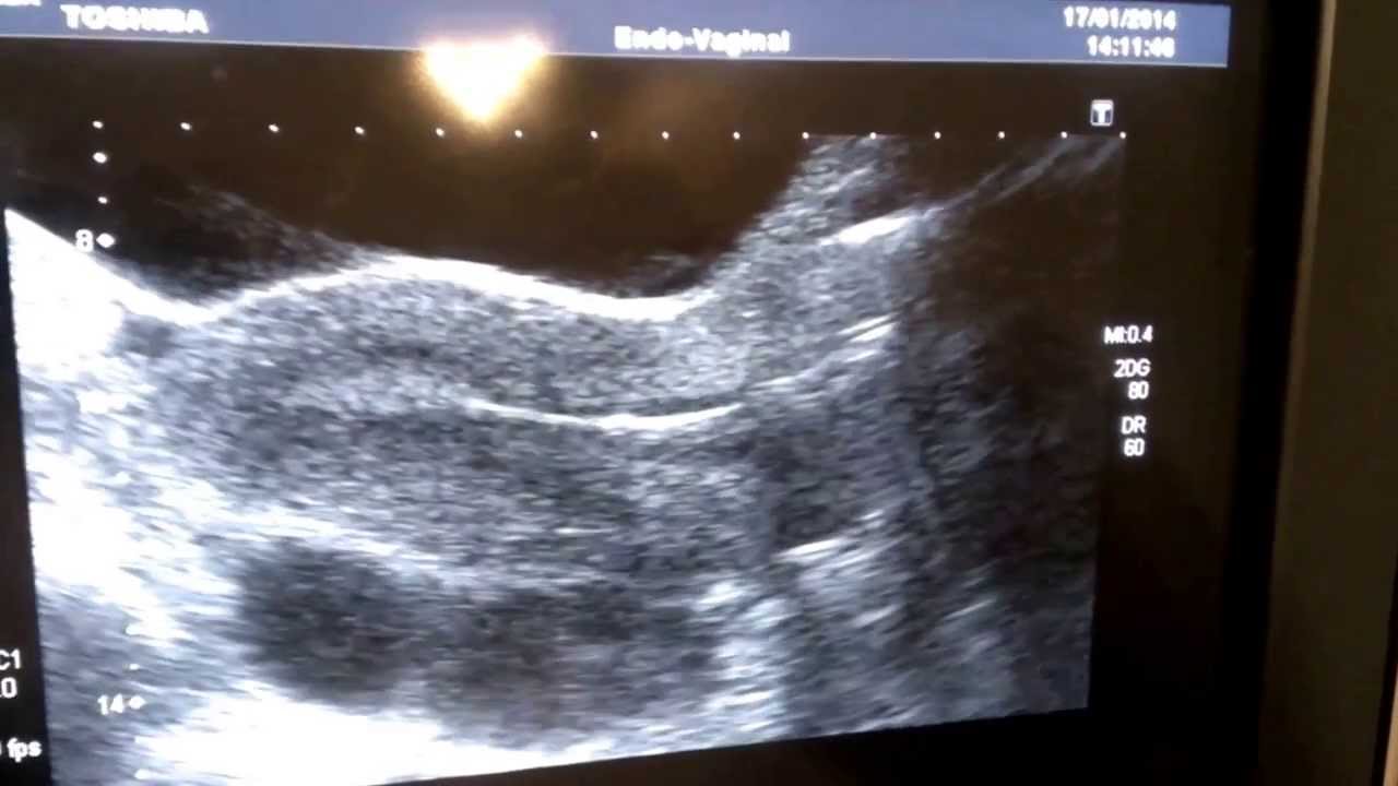 transferencia embrionaria de FIV