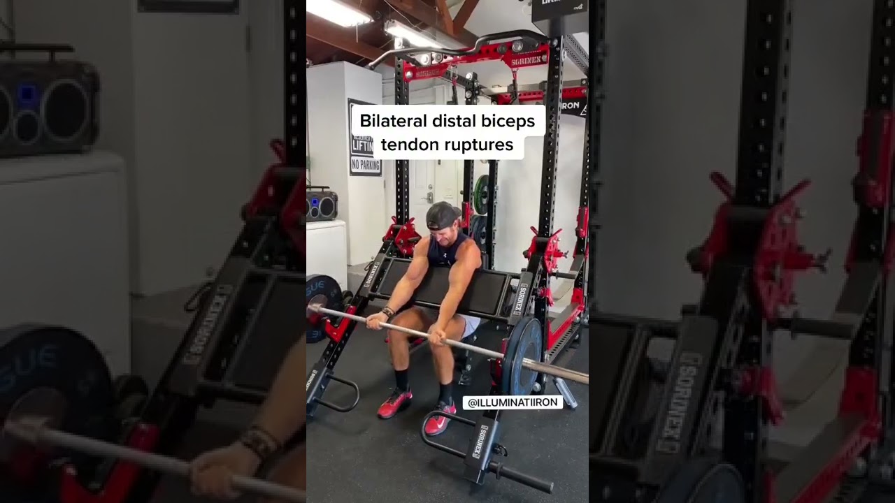 Bilateral Distal Biceps Tendon Rupture (RARE) #shorts