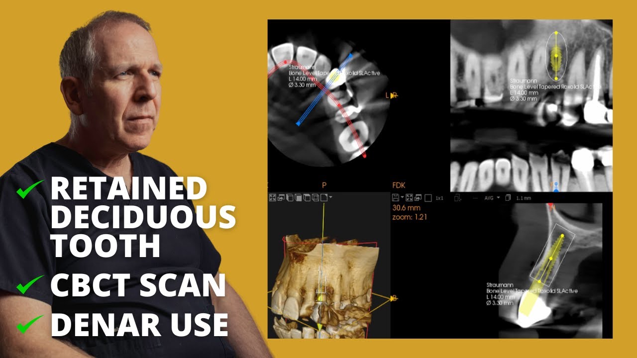 Implant Planning using CBCT - Dentistry Case by Dominic Hassall