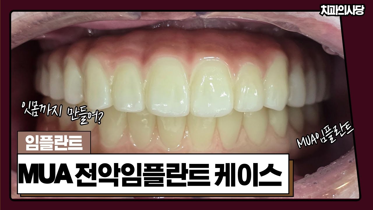 오랜틀니사용, 한쪽만 무너진 잇몸? 🦷 'MUA 전악임플란트'로 잃어버린 대칭을 찾았습니다! (고난도 전체 임플란트 실제 사례)
