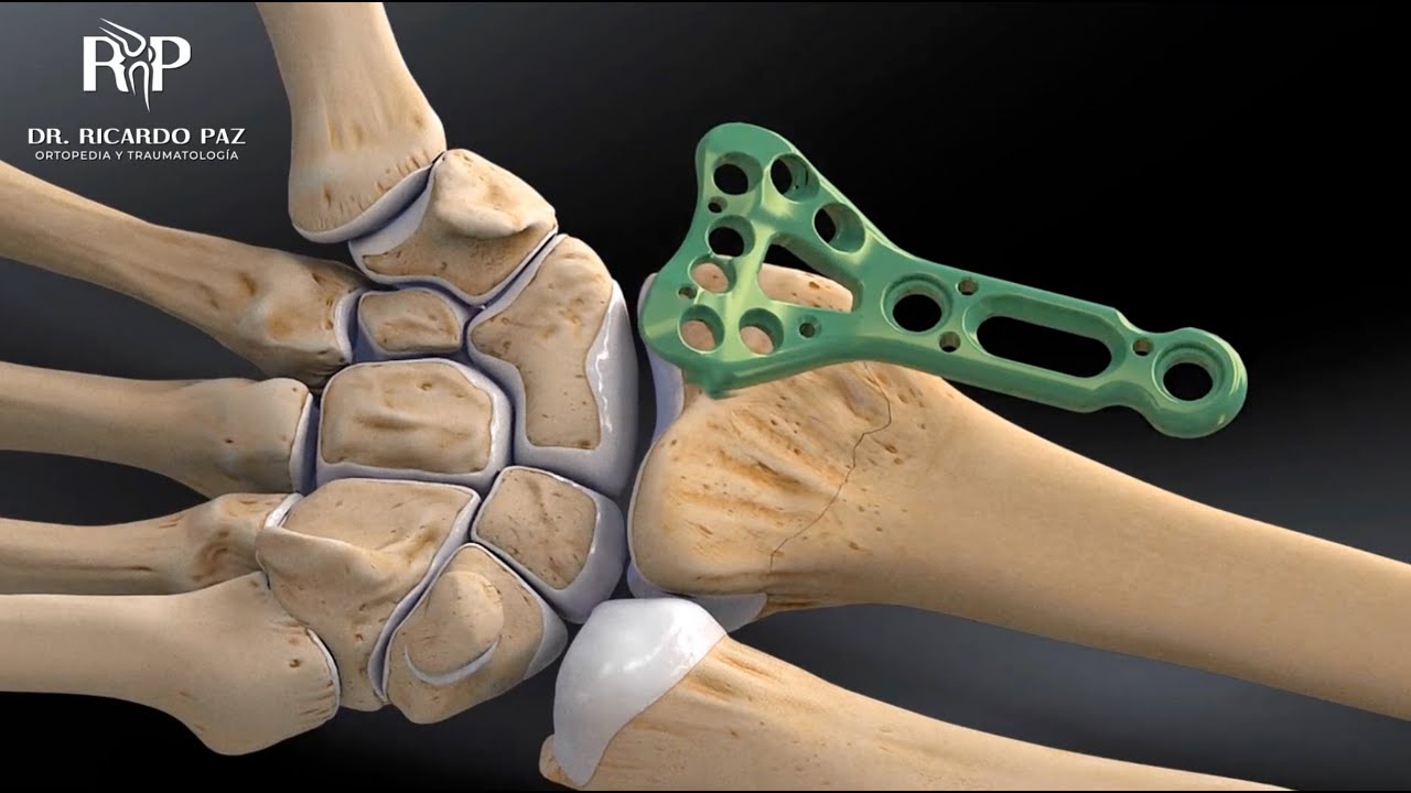 Fractura de Radio Distal #casoclínico #muñeca #mano