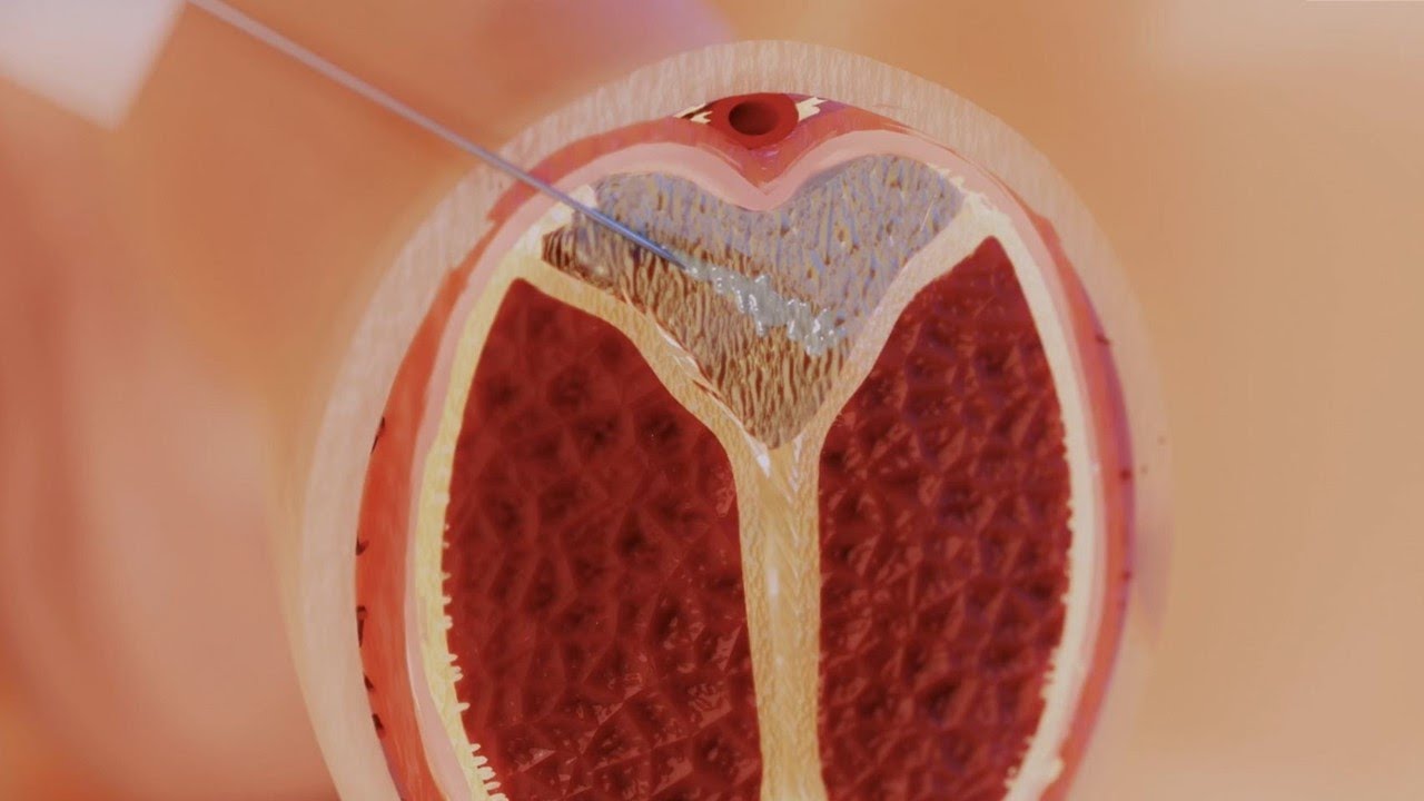 Optimizing Outcomes with Xiaflex Injections