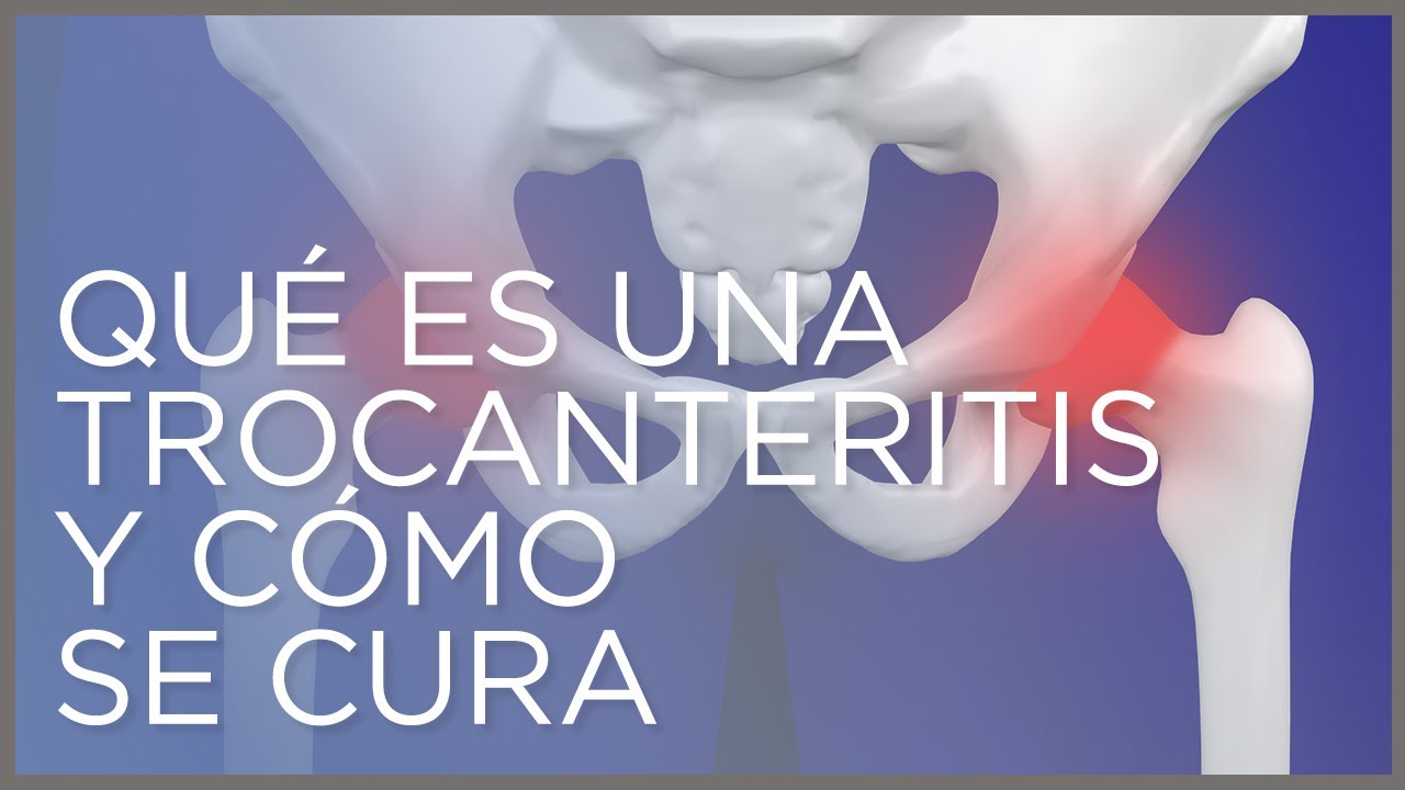 Qu&eacute; es una #trocanteritis y c&oacute;mo se cura