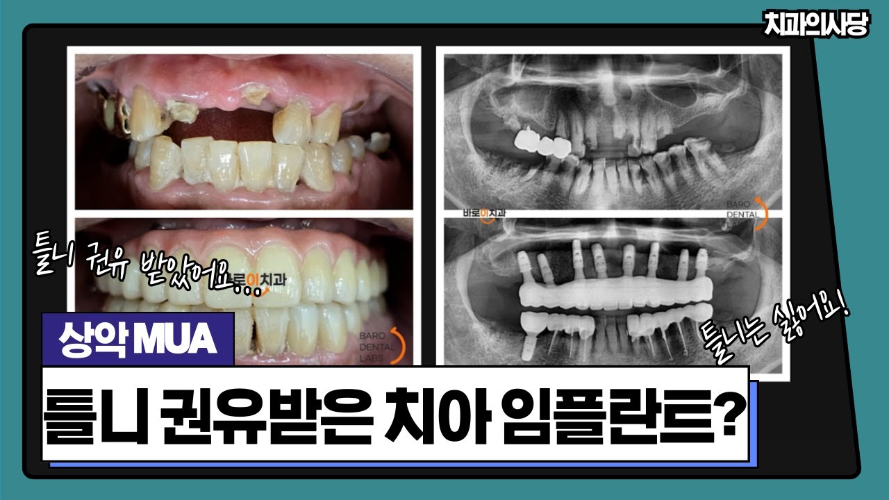 틀니만 강요받던 분의 상악 MUA 전악 임플란트 대반전 케이스