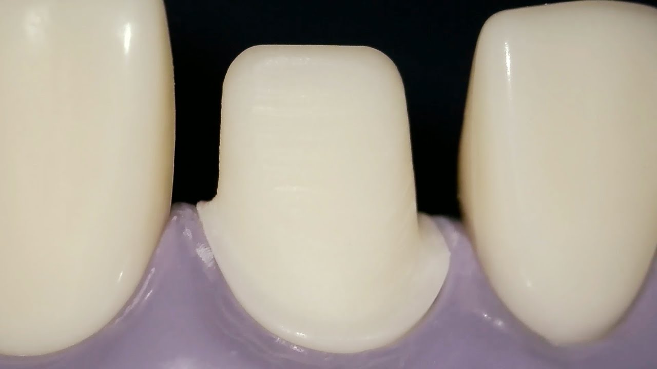#8 tooth prep