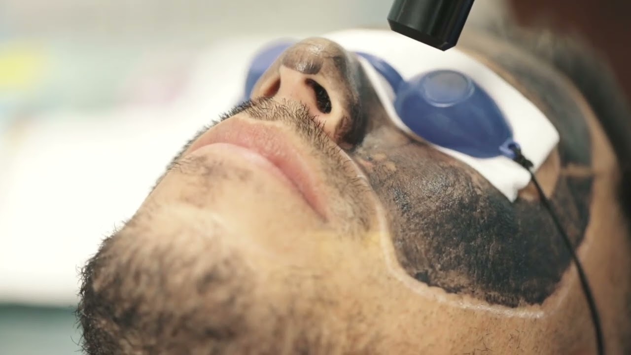 Carbon Peel