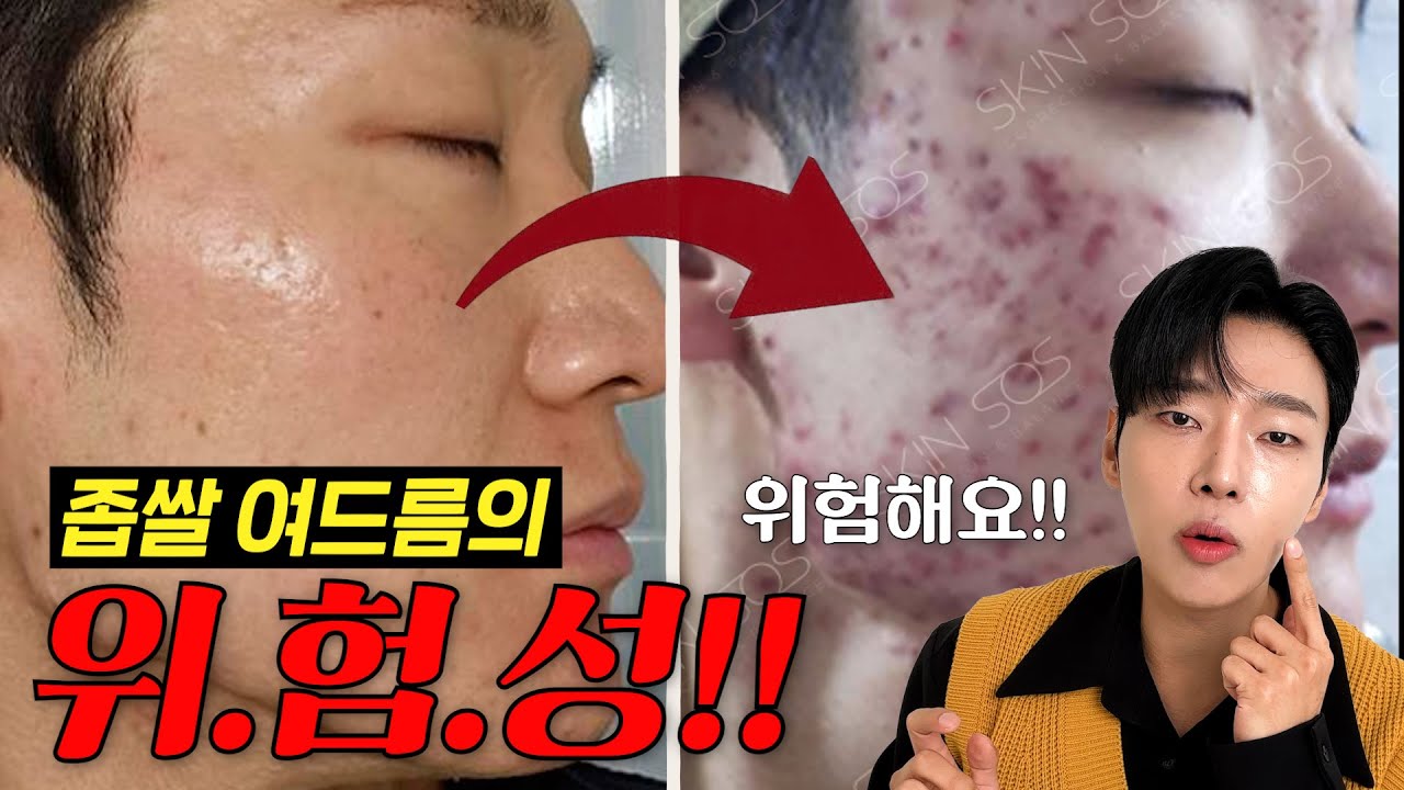 좁쌀여드름 예방&박살내는 방법!│좁쌀여드름의 위험성