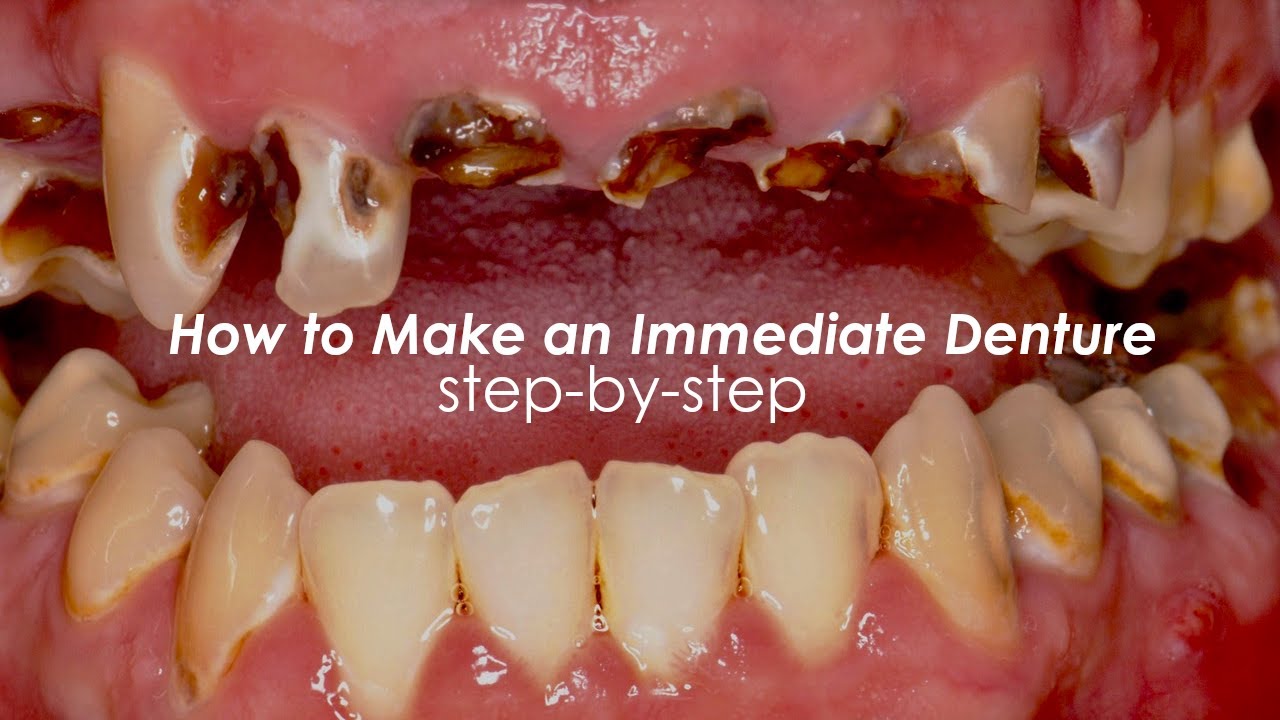 How to Make an Immediate Denture, Step-By-Step