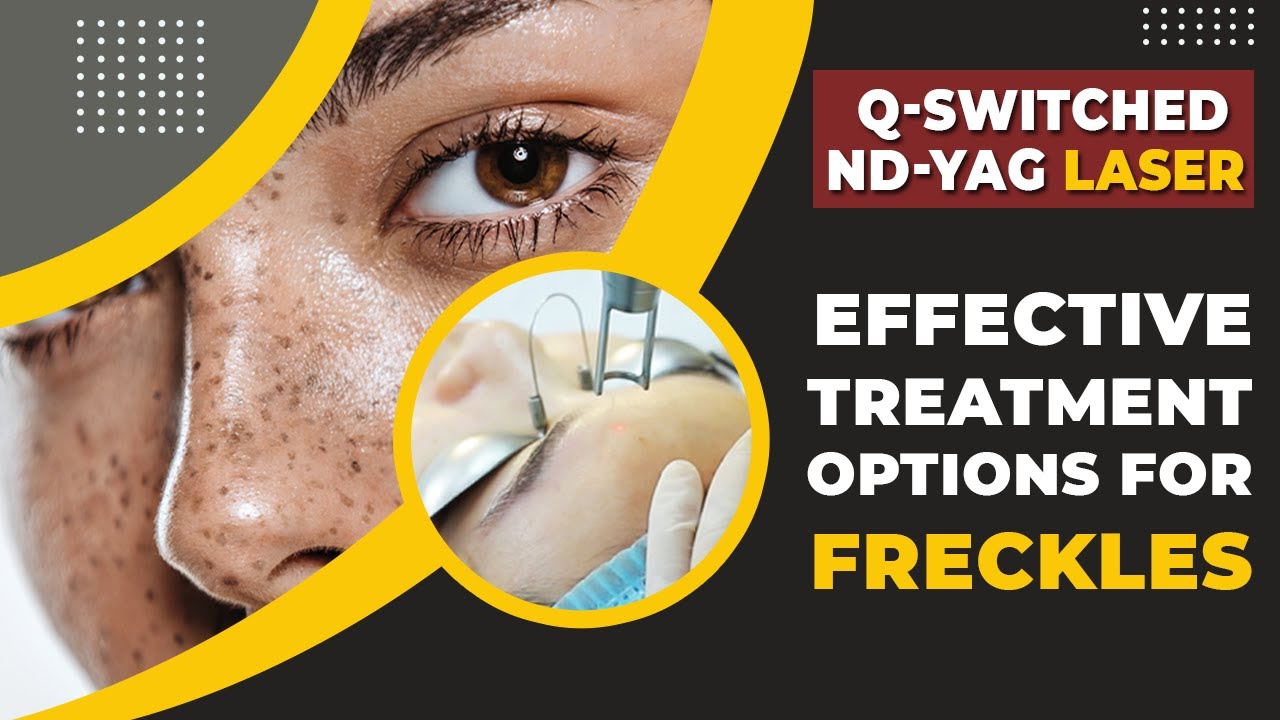 Q-Switched Laser Treatment for Freckles | Freckle Removal Treatment in Delhi | Dr. PK Talwar