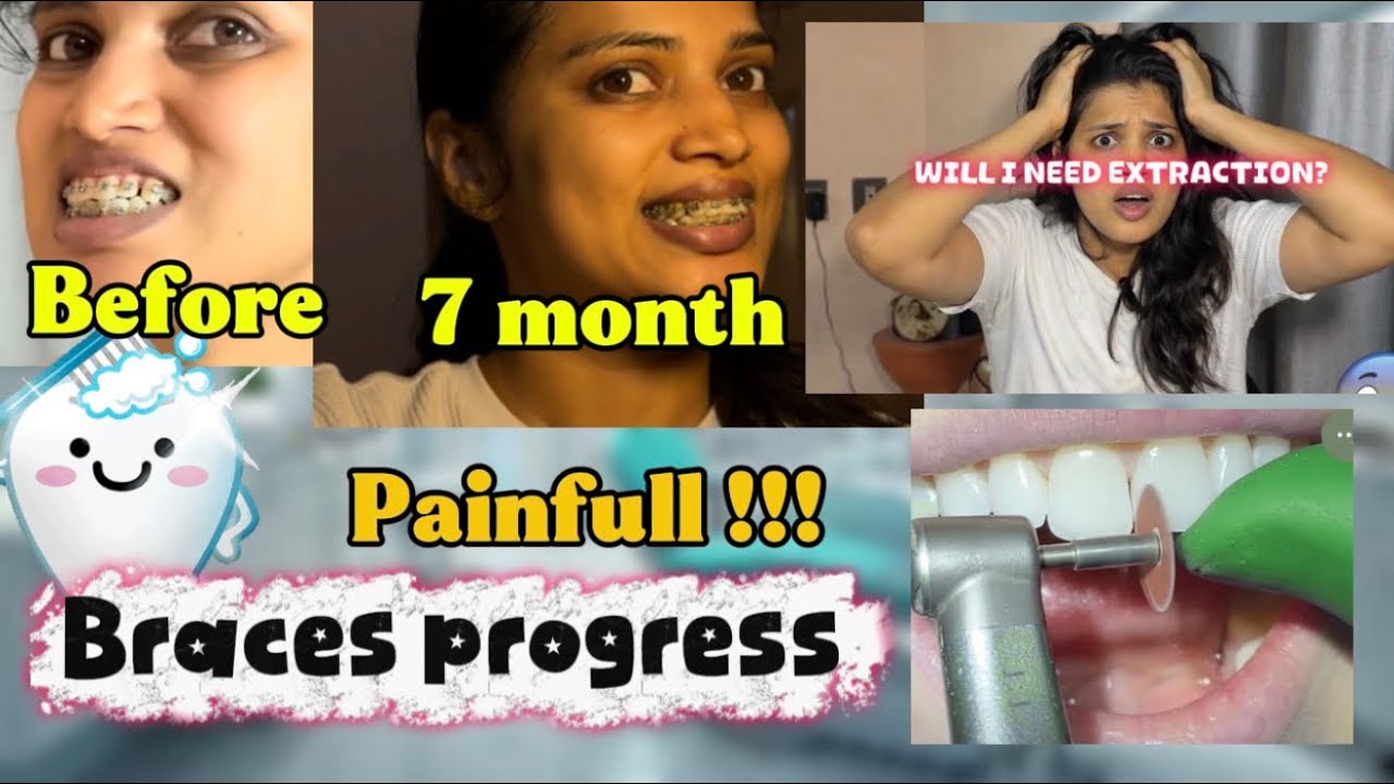 7 Months Braces Update 😬🦷| Gap Closing Progress | My Braces Journey #braces #transformation
