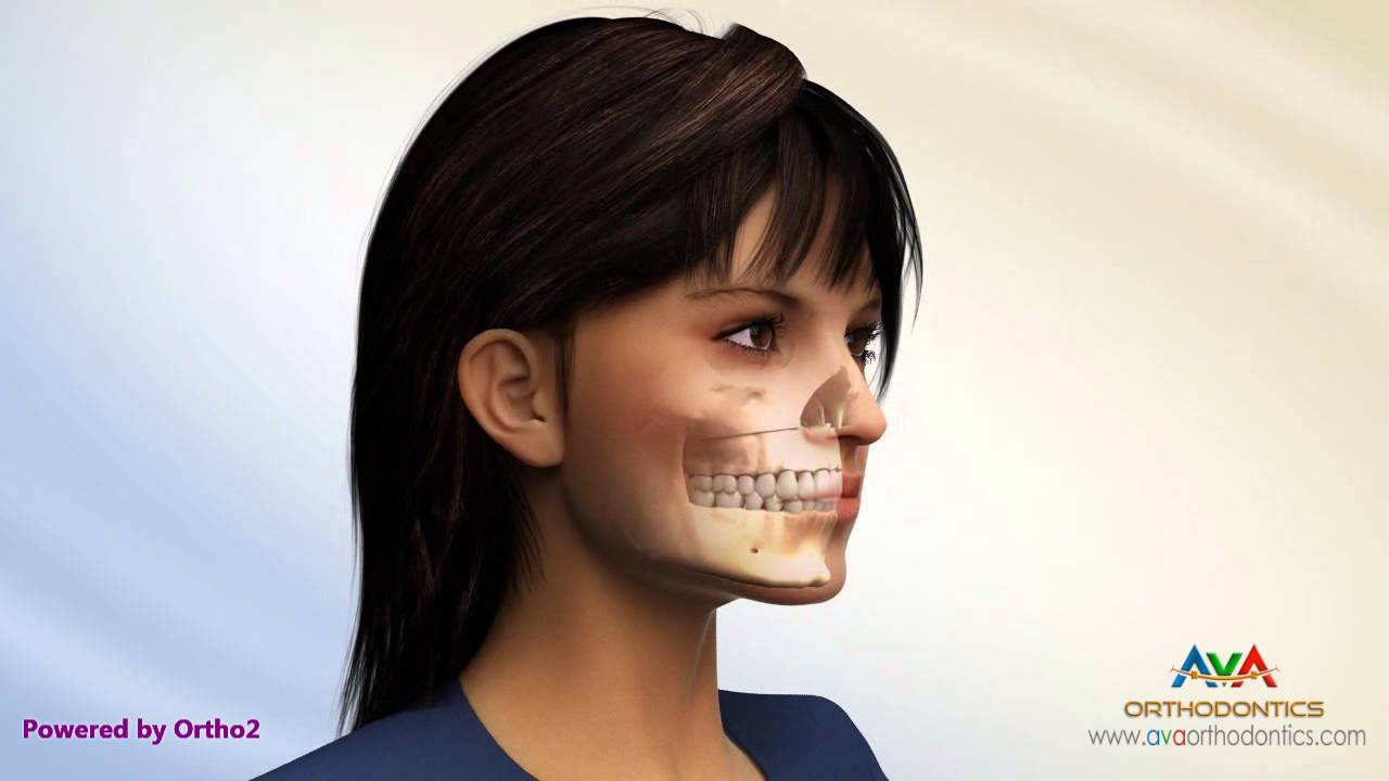 Surgical Orthodontic Treatment - Different Procedures