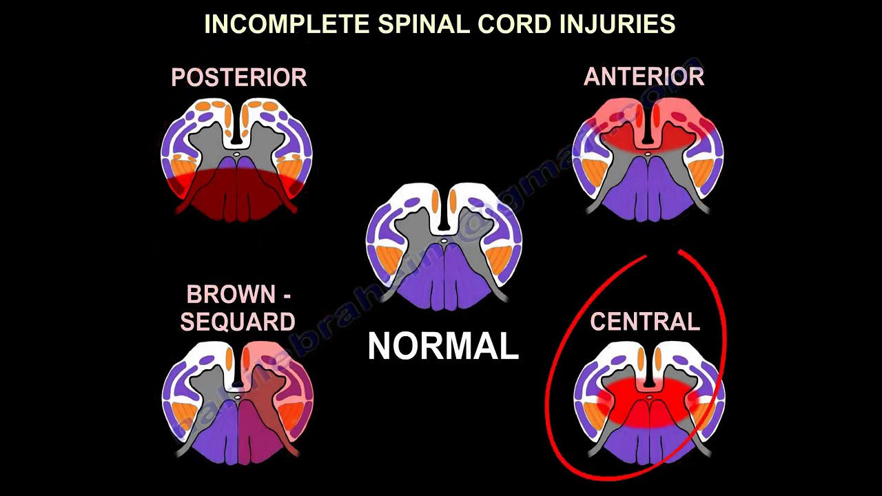Spinal Cord Injury, Detailed