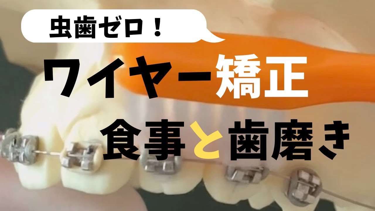 ワイヤー矯正（マルチブラケット）装置の食事と歯磨き