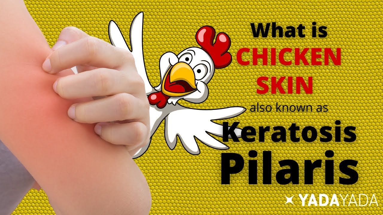 Are Your Arms Rough & Bumpy? - KERATOSIS PILARIS - Chicken Skin or Strawberry Skin - Tips to Help
