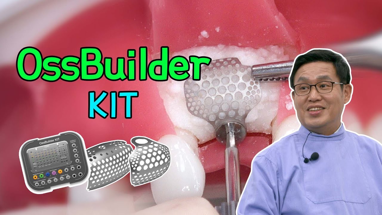 [EASY Hands-on] OssBuilder KIT - OB2 Case and 2 stage GBR with Tenting screw
