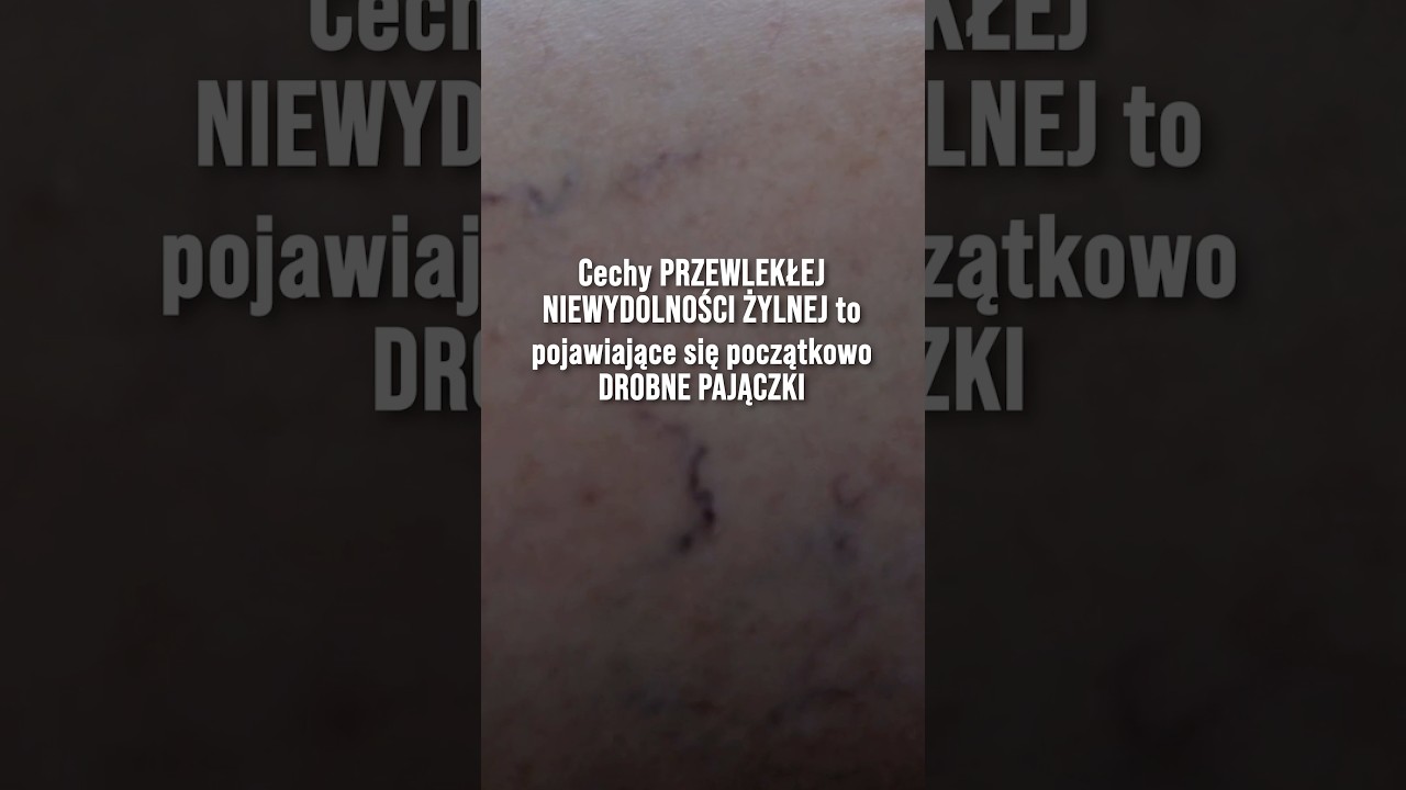 Jaki się cechy przewlekłej niewydolności żylnej?