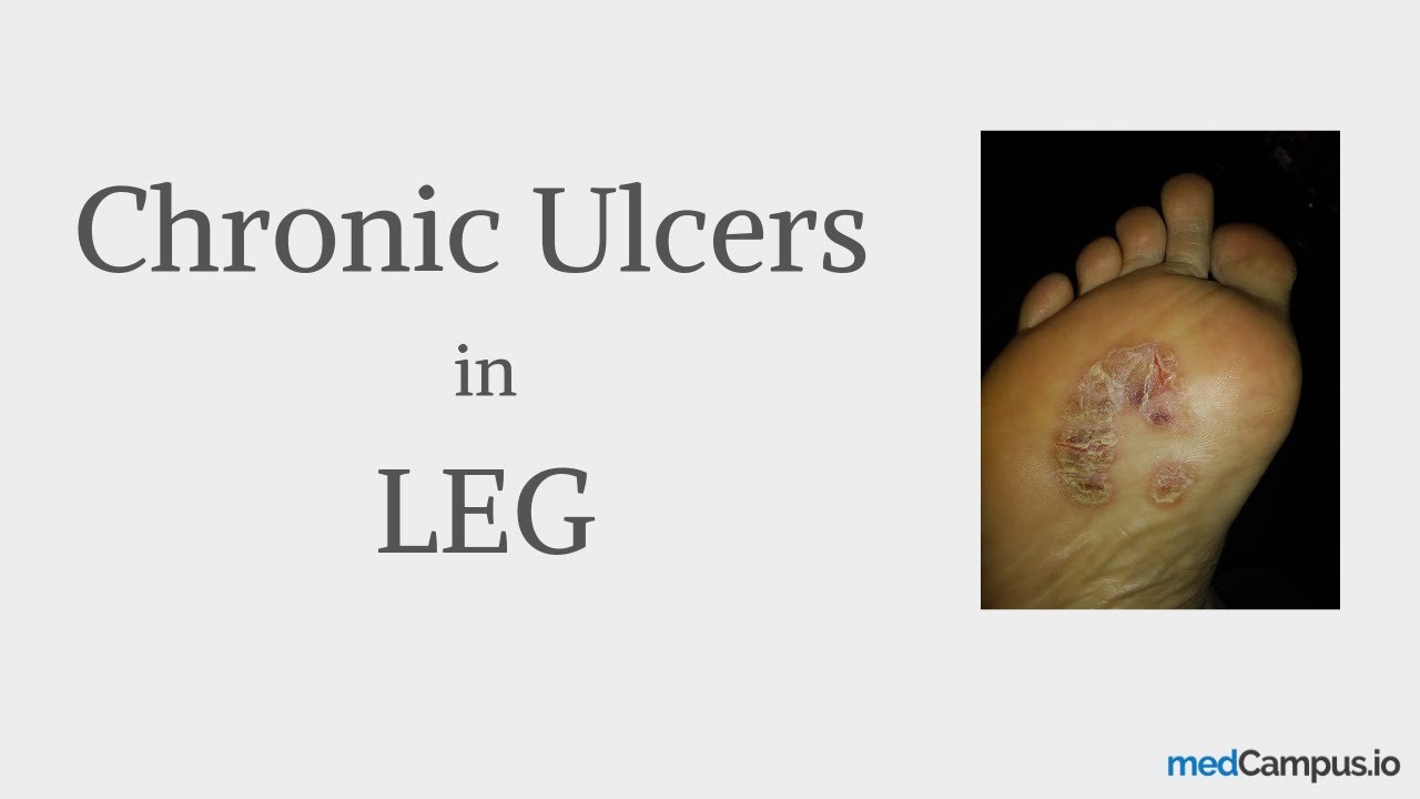Causes of Chronic Ulcers | In Leg