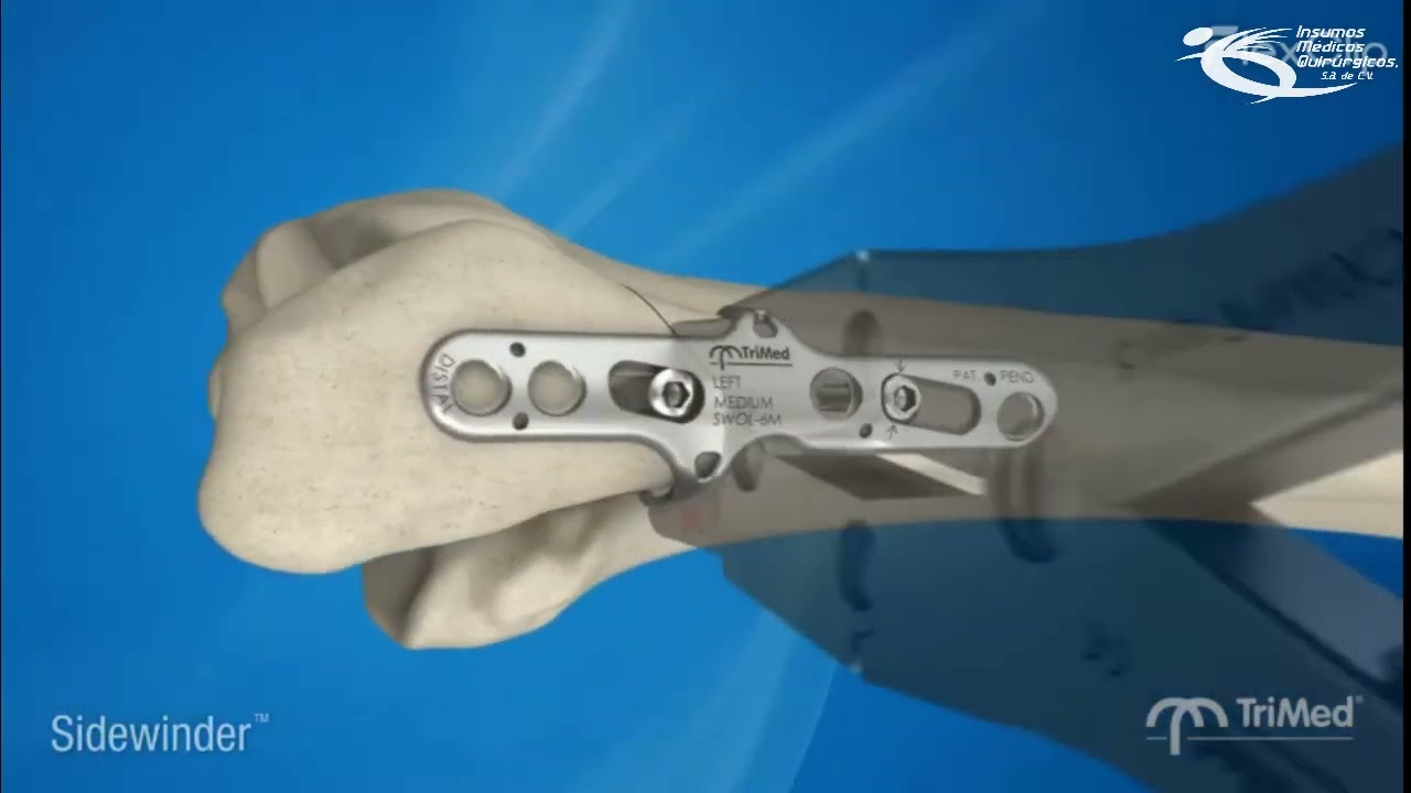 Placa Sidewinder Trimed - Insumos M&eacute;dicos Quir&uacute;rgicos