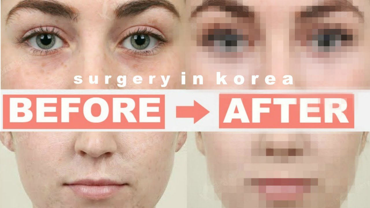 I GOT PLASTIC SURGERY IN KOREA... was it worth it? | seoul guide medical