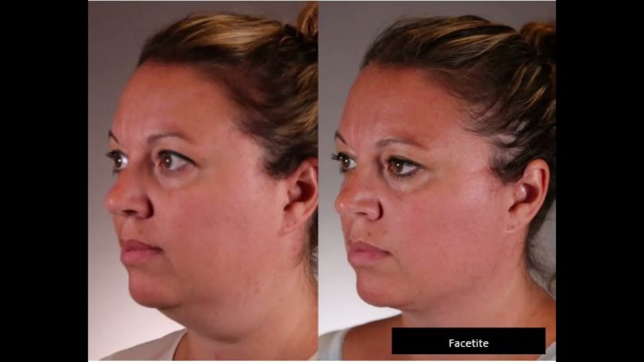 Facetite, Morpheus8 en Accutite RF-technologie