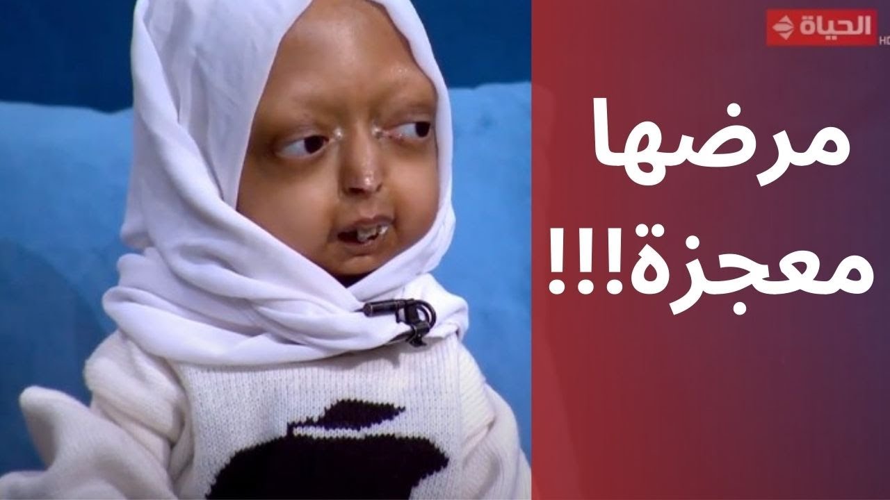 قصة أغرب من الخيال 💔مرض نادر للطفلة ألاء يوجع القلب وعرفنا الحكاية من رسالة على الفيسبوك