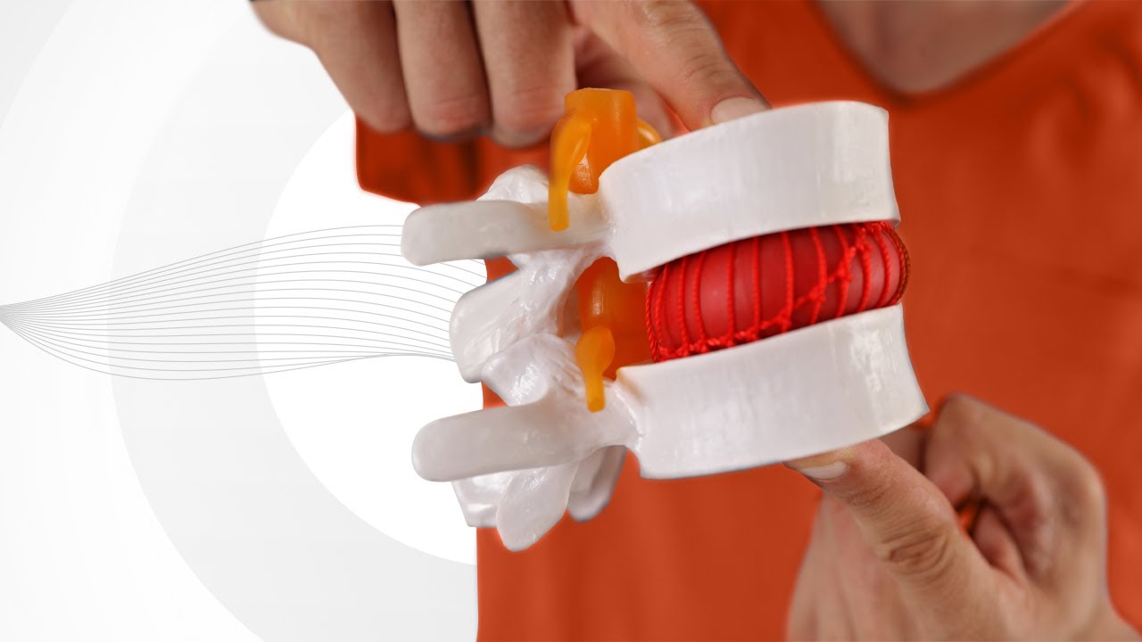 Spinal Disc Herniation: Causes & Treatment