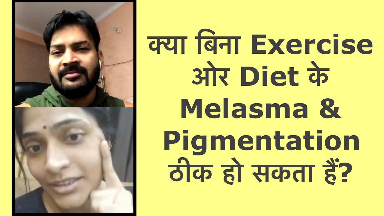 Can Pigmentation/Melasma cure without Diet & Exercise क्या बिना व्याम ओर खुराक के झाइयाँ जा सकती है?