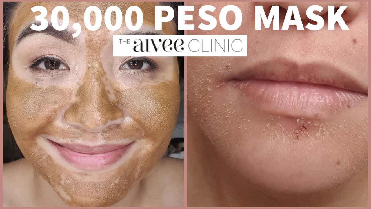 30,000 PESO MASK| COSMELAN FOLLOW-UP| 8 MONTHS AFTER| NOT SPONSORED| Mrs. F🍒