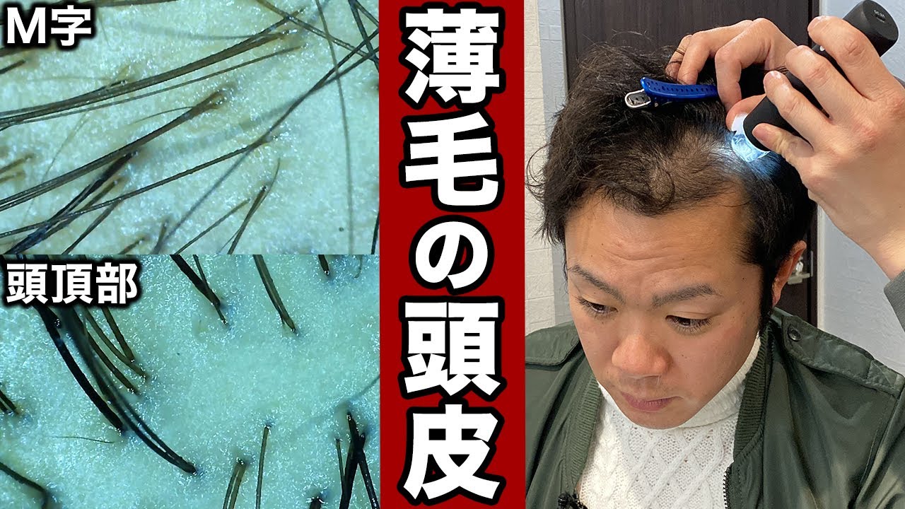 【AGAの頭皮】マイクロスコープで薄毛の人の性質を解説！