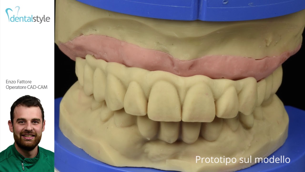 Dentalstyle - Toronto full digital in titanio fresato e composito in stampa 3D