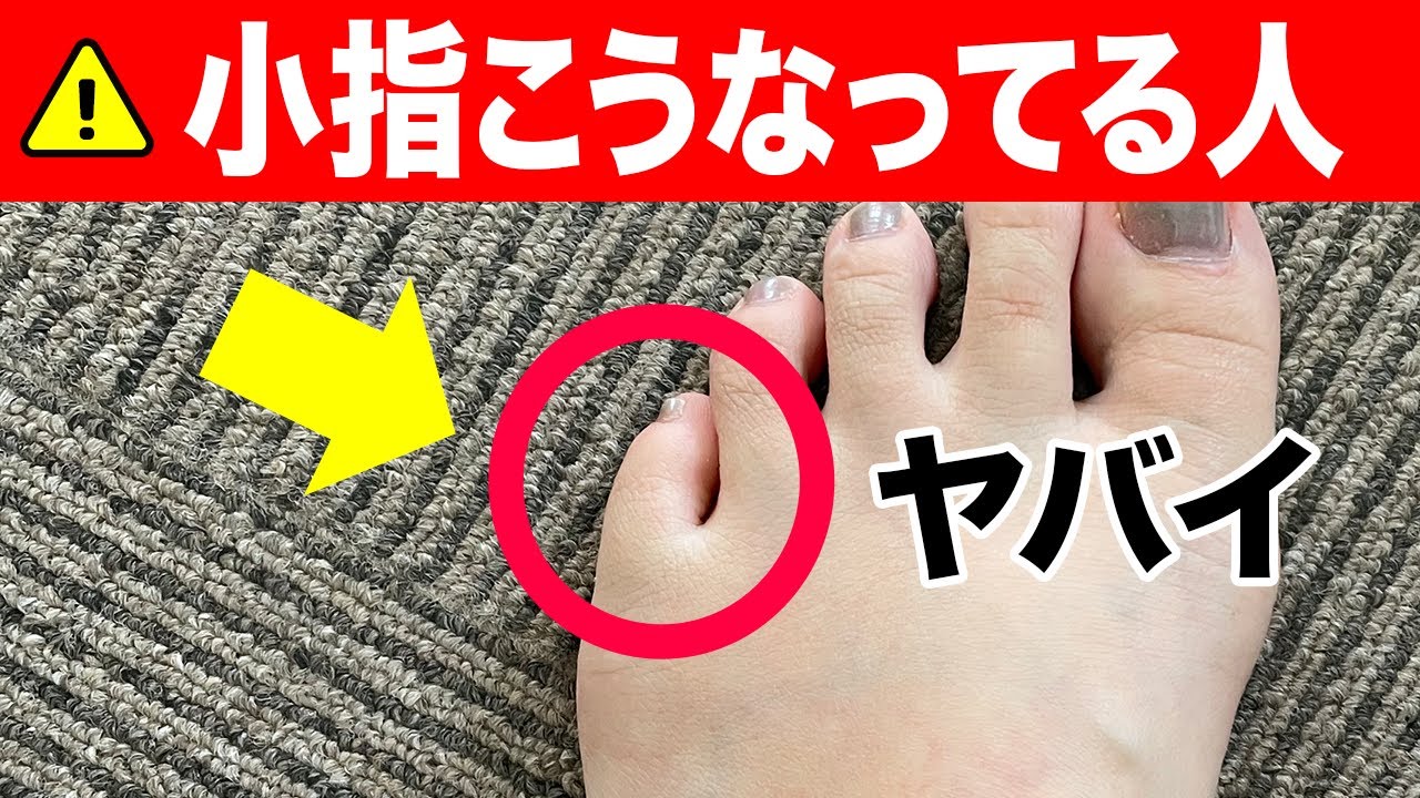 足の小指が寝指になっていると太ります。