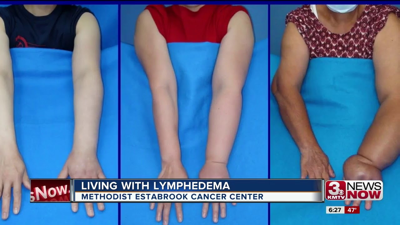 Living with Lymphedema