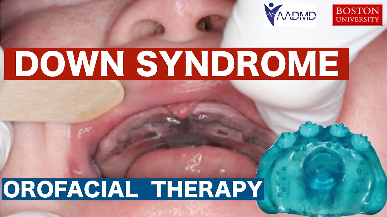 Down Syndrome: Orofacial Therapy.