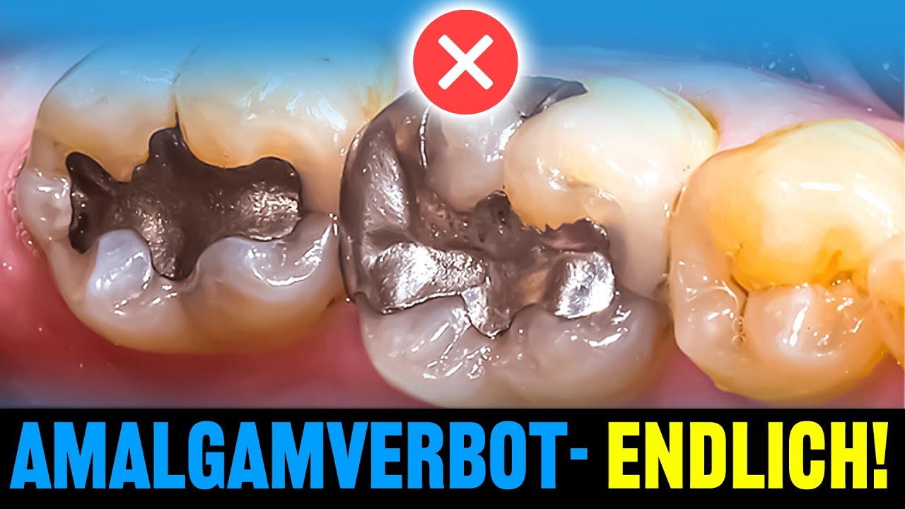 Amalgamverbot- ENDLICH ist es soweit!