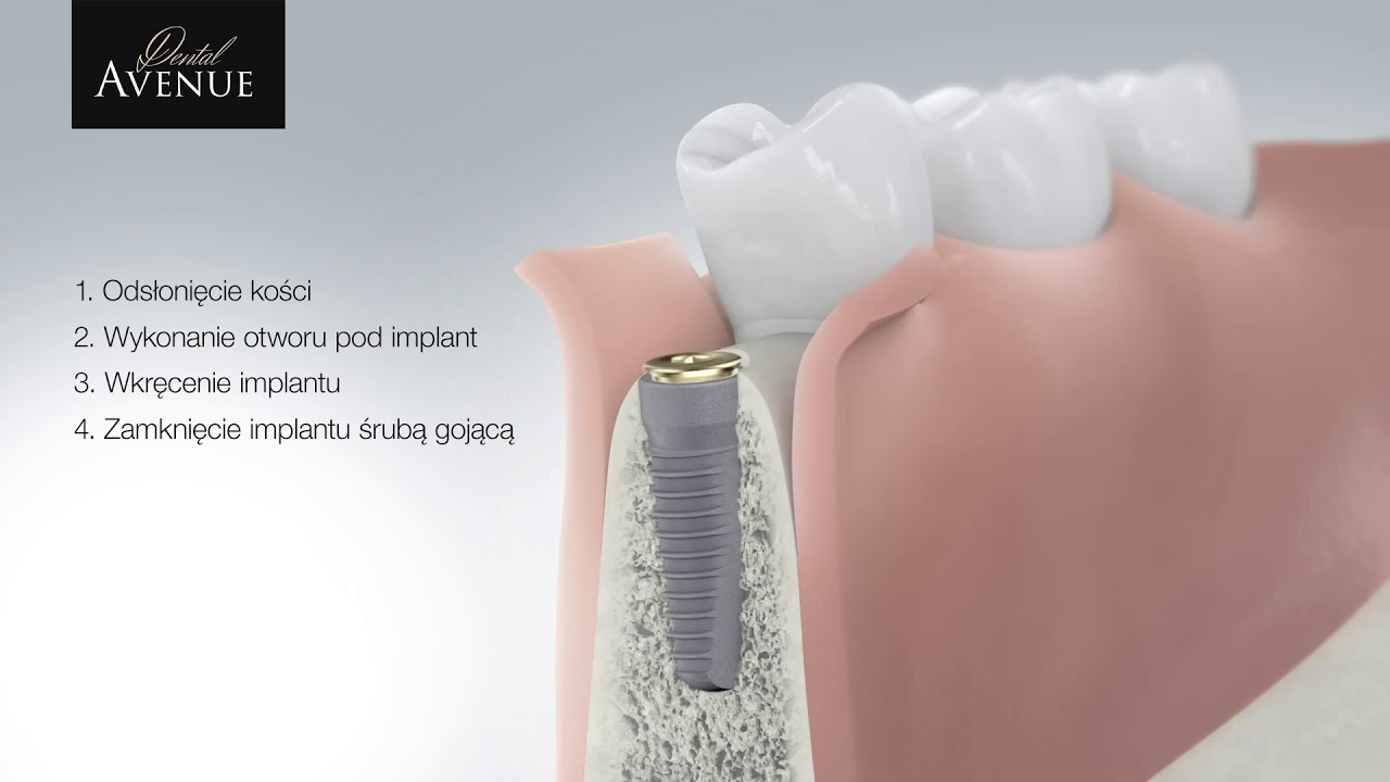 Jak wygląda wszczepienie implantu?