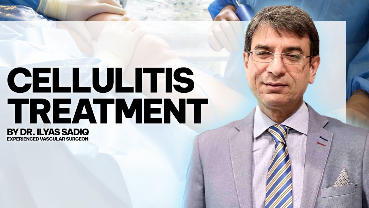 Cellulitis Ka Ilaj in Urdu / Hindi Dr. Illas Sadiq Vascular Surgeon