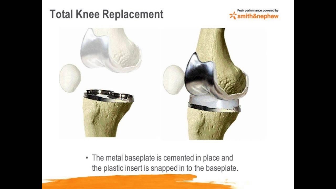 Knee Pain - Dr. Robert Daley, Silver Cross Hospital